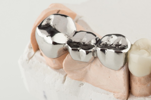 Bridged dental prostheses are made of steel and ceramic paste