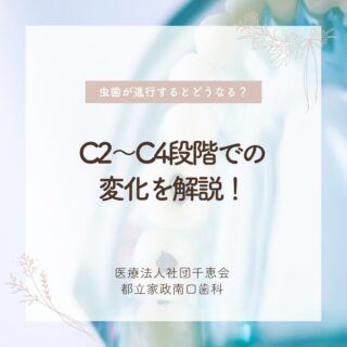 こんにちは🌟
都立家政南口歯科です🦷

虫歯が進行すると、「しみる」「ズキズキ痛む」などの症状が現れます💦

C2の段階で治療を始めれば歯を残せる可能性が高いですが、
C3・C4まで進むと神経をとる処置や抜歯が必要になることも。

少しでも違和感を感じたら、早めに受診をしましょう✨

🦷【都立家政南口歯科】🦷
〒165-0033
住所:東京都中野区若宮3丁目17−6　メゾンドグリシーヌ1F

#都立家政南口歯科#東京都#中野#中野の歯医者さん#歯科医院#歯科医師#歯科衛生士#虫歯#抜歯
