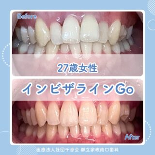 こんにちは🌟
都立家政南口歯科です🦷

今回はインビザラインGoの症例をご紹介します📸

詳細は画像内に記載しておりますので、
ぜひご覧いただき少しでも気になる方は
お気軽にお問合せください✨

🦷【都立家政南口歯科】🦷
〒165-0033
住所:東京都中野区若宮3丁目17−6　メゾンドグリシーヌ1F

#都立家政南口歯科 #中野の歯医者さん #東京歯医者
#インビザライン #矯正治療