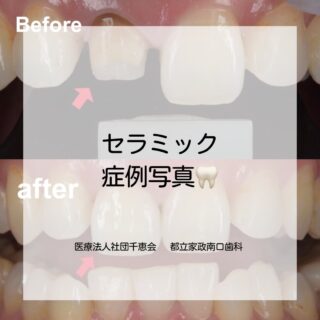 こんにちは⭐️
都立家政南口歯科です🦷
＝＝＝＝＝＝＝＝＝＝
⁡
セラミックの症例写真のご紹介です📸

前歯の変色が気になるとのことで、セラミッククラウン治療を行いました。

周囲の歯になじむよう、色味・透明感・形態を調整し、自然な前歯を再現しています。

また、歯科技工士立ち会いのもと、色味や質感を細かく確認しながら製作を行っています。

前歯はお顔の印象にも関わるため、
「白すぎない自然さ」も大切にしています。

【年齢・性別】
30代女性

【治療内容】
右上1番 クラウン治療（ジルコニアボンド）

【治療期間】
1ヶ月

【通院回数】
3回

【費用】
220,000円（税込）

【リスク・副作用】
・神経がある歯の場合、一時的にしみる症状が出ることがあります 
・神経を取っている歯の場合、将来的に根の先に炎症が起こり、再治療が必要になることがあります 
・強い衝撃や食いしばりにより、セラミックが欠ける可能性があります

#セラミック治療 #前歯治療 #審美歯科 #都立家政 #都立家政南口歯科 
＝＝＝＝＝＝＝＝＝＝
🦷【都立家政南口歯科】🦷
〒165-0033
住所:東京都中野区若宮3丁目17-6
メゾンドグリシーヌ1階