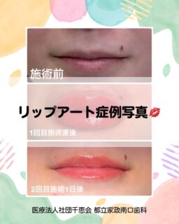 こんにちは🌟
都立家政南口歯科です🦷

💋リップアートメイク症例のご紹介💋

【症例①】
お悩み：すっぴんでも唇に血色感がほしい

自然な血色をプラスし、
ノーメイクでも明るい印象のお口元へ✨

【症例②】
お悩み：唇のくすみが気になる

くすみをカバーし、
透明感のある美しい唇へ✨

現在、モニターキャンペーン実施中🌸

通常価格：120,000円（税込）
モニター価格：80,000円（税込）

📢先着3名限定
残り2名となっております！

気になる方はお気軽にカウンセリングへお越しください😊💐
⁡

🦷【都立家政南口歯科】🦷
〒165-0033
住所:東京都中野区若宮3丁目17−6　メゾンドグリシーヌ1F

#都立家政南口歯科 #中野の歯医者さん #東京歯医者 #リップアート  #美容医療