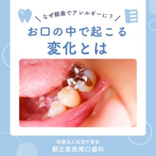 こんにちは🌟
都立家政南口歯科です🦷

金属アレルギーと聞くと、
ネックレスや指輪などを思い浮かべる方も
多いのではないでしょうか？💭

実は歯科治療で使用される銀歯も、
金属アレルギーの原因になることがあります。

銀歯は複数の金属を使用した素材で作られており、
長期間お口の中にあることで、
金属成分が少しずつ溶け出すことがあります。

その金属に体が反応すると、
アレルギー症状につながる場合もあります⚠️

現在銀歯が入っていて気になる症状がある方や、
これから詰め物・被せ物を検討されている方は
お気軽にご相談ください😊

🦷【都立家政南口歯科】🦷
〒165-0033
住所:東京都中野区若宮3丁目17−6　メゾンドグリシーヌ1F

#都立家政南口歯科 #中野の歯医者さん #都立家政駅
#都立家政歯医者 #中野区若宮